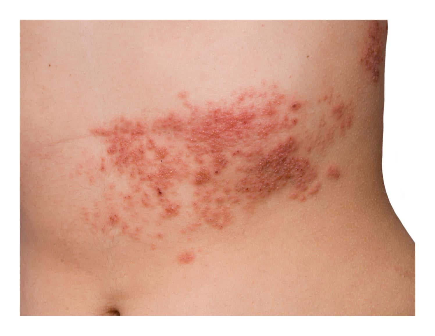 Is shingles contagious, what are shingles, herpes zoster pictures ...