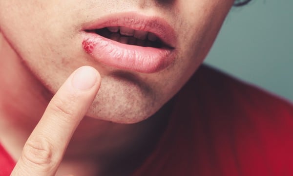 Is there a permanent cure for oral herpes?
