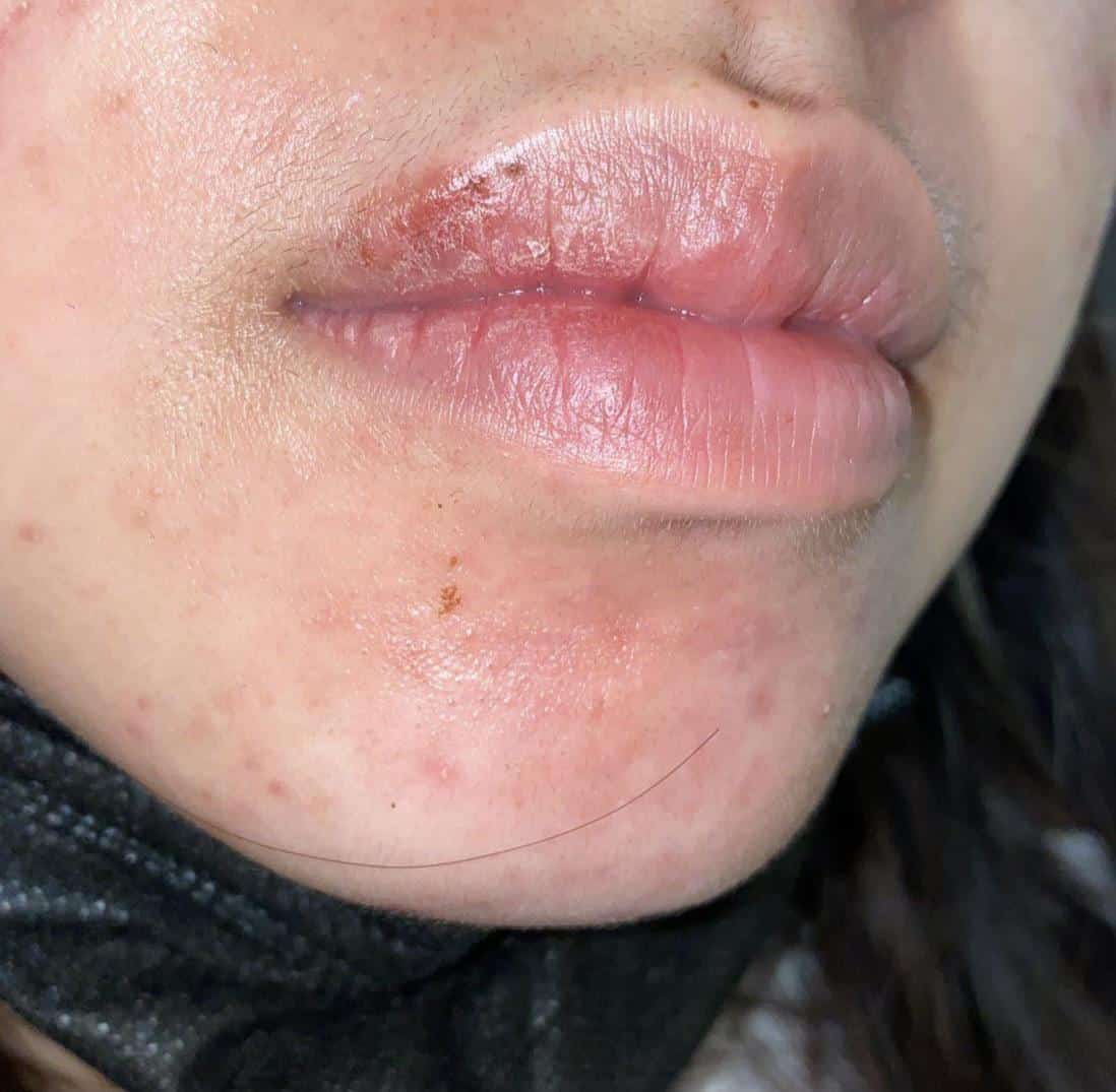 Is this a cold sore? It didnât blister or anything like that. It just ...