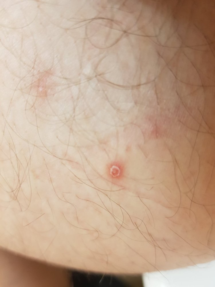 Is This Genital Herpes? Can Anyone Help?