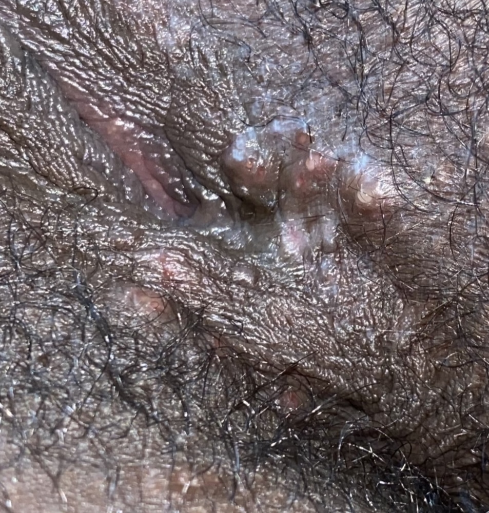 IS this herpes? I havent had sex in 2 years!?!