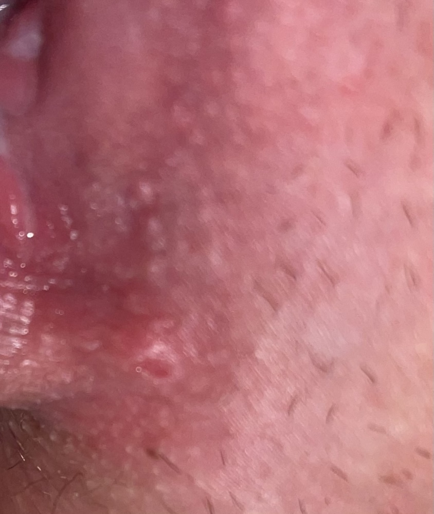 is this herpes? im really nervous.