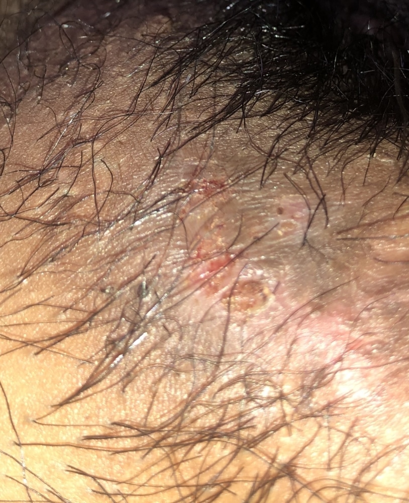 Is this herpes? My doctor says its not