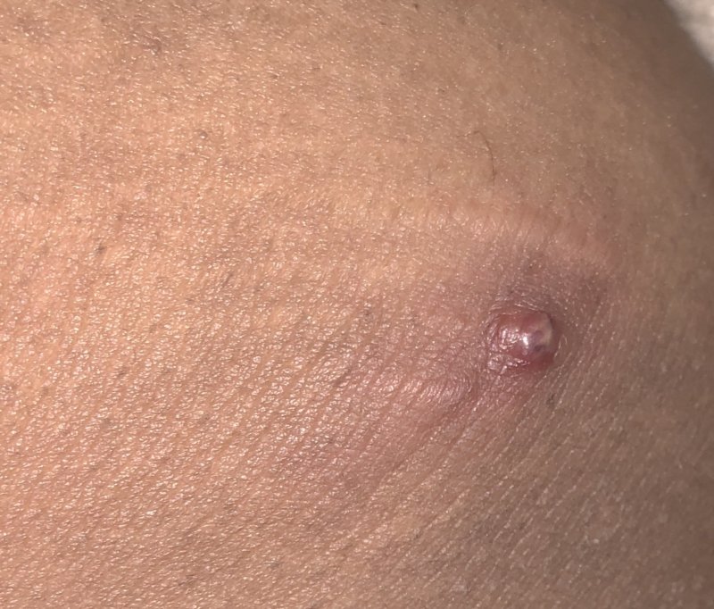 Is this herpes or a pimple? (PICTURES)