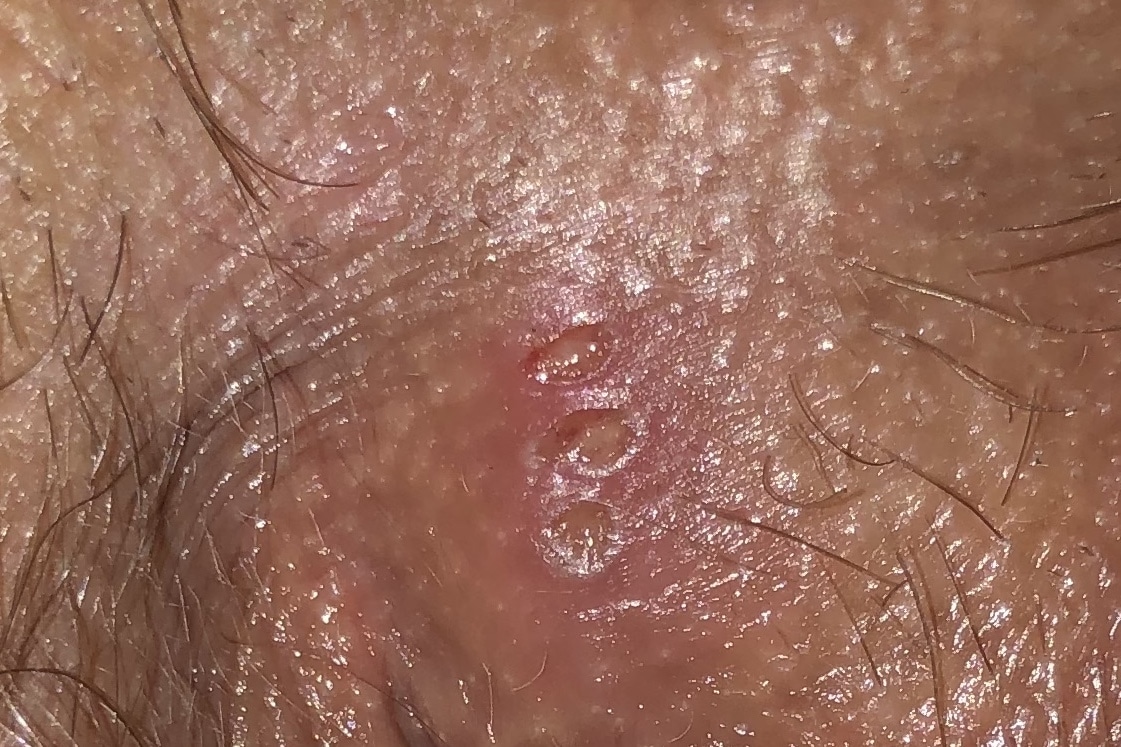 Is this herpes or something else???