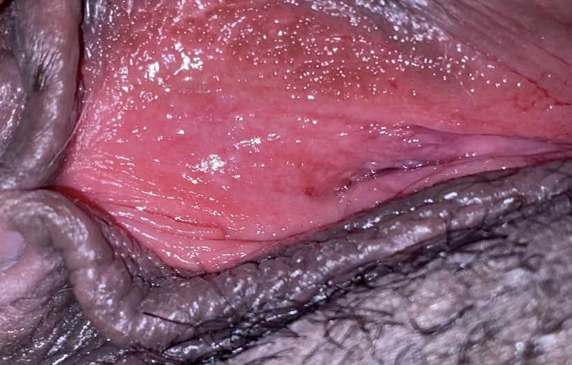Is this herpes or something else?? Very scared