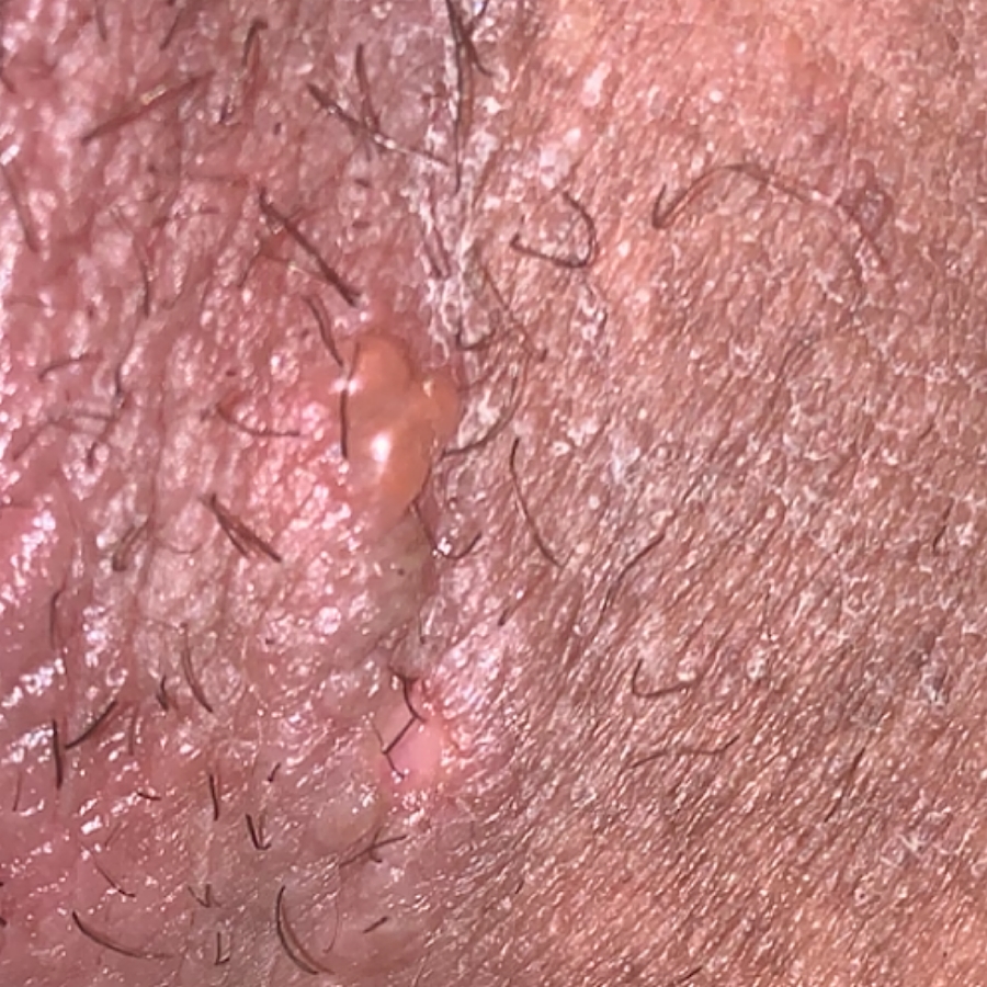 Is this herpes ?? Please help