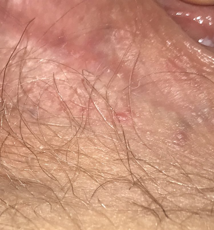 Is this Herpes?! Please help! (Pictures)
