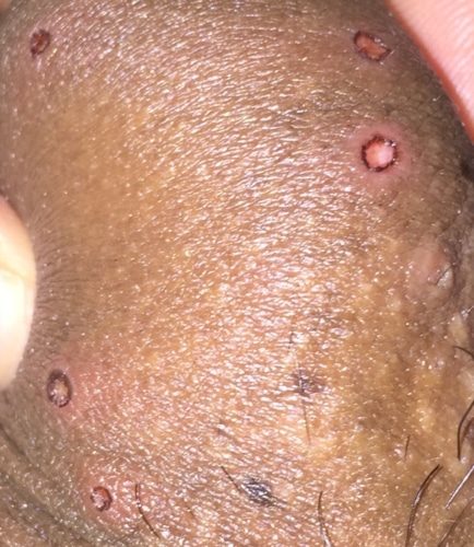 Is this herpes? What is this? Please help