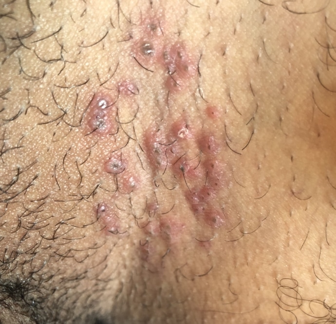 IS THIS HERPS OR other infection?