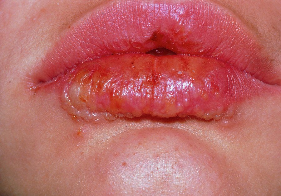 Lips Infected By The Herpes Simplex Virus Photograph by Science Photo ...