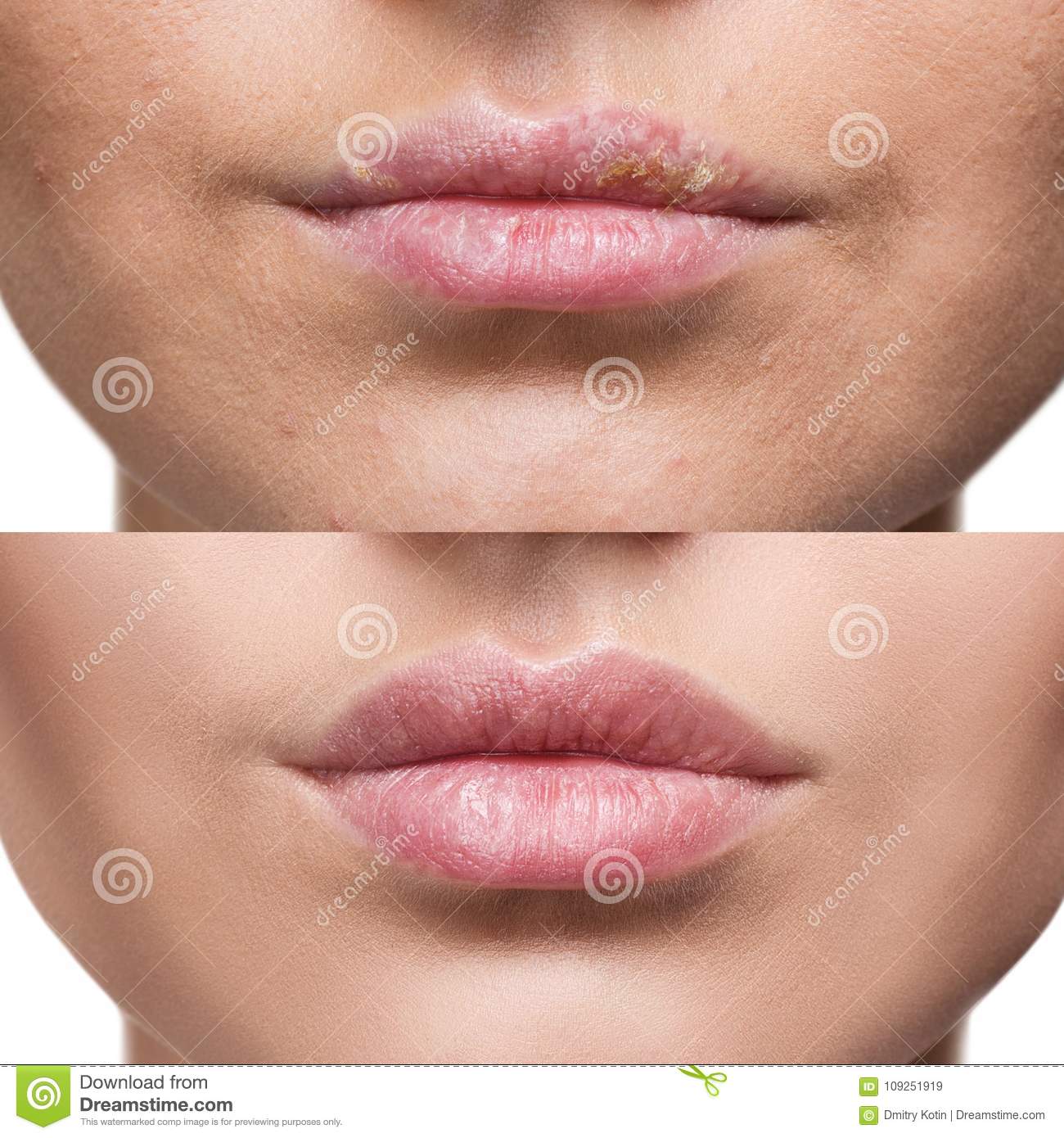 Lips with Herpes before and after Treatment. Stock Image