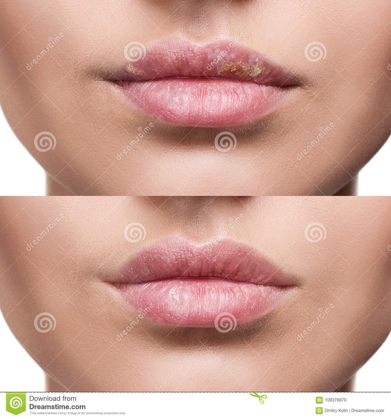 Lips With Herpes Before And After Treatment. Stock Photo