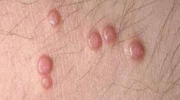 Lump on Inner Thigh, Small, Red Bumps, Painful Lumps Female, Male Lump ...