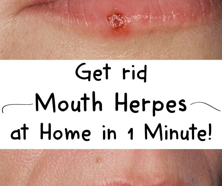 Medicine For Oral Herpes