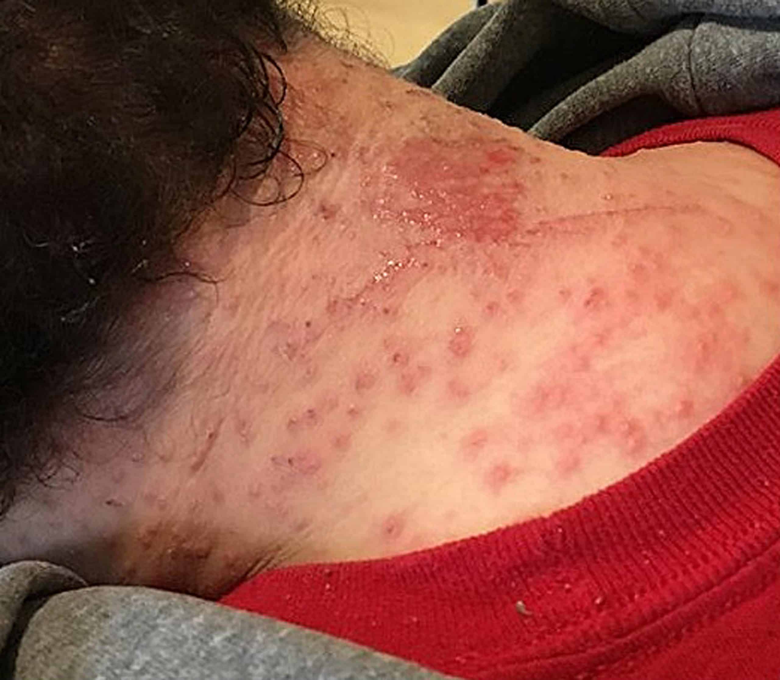 Mum scarred by horrific allergic reaction to hair dye