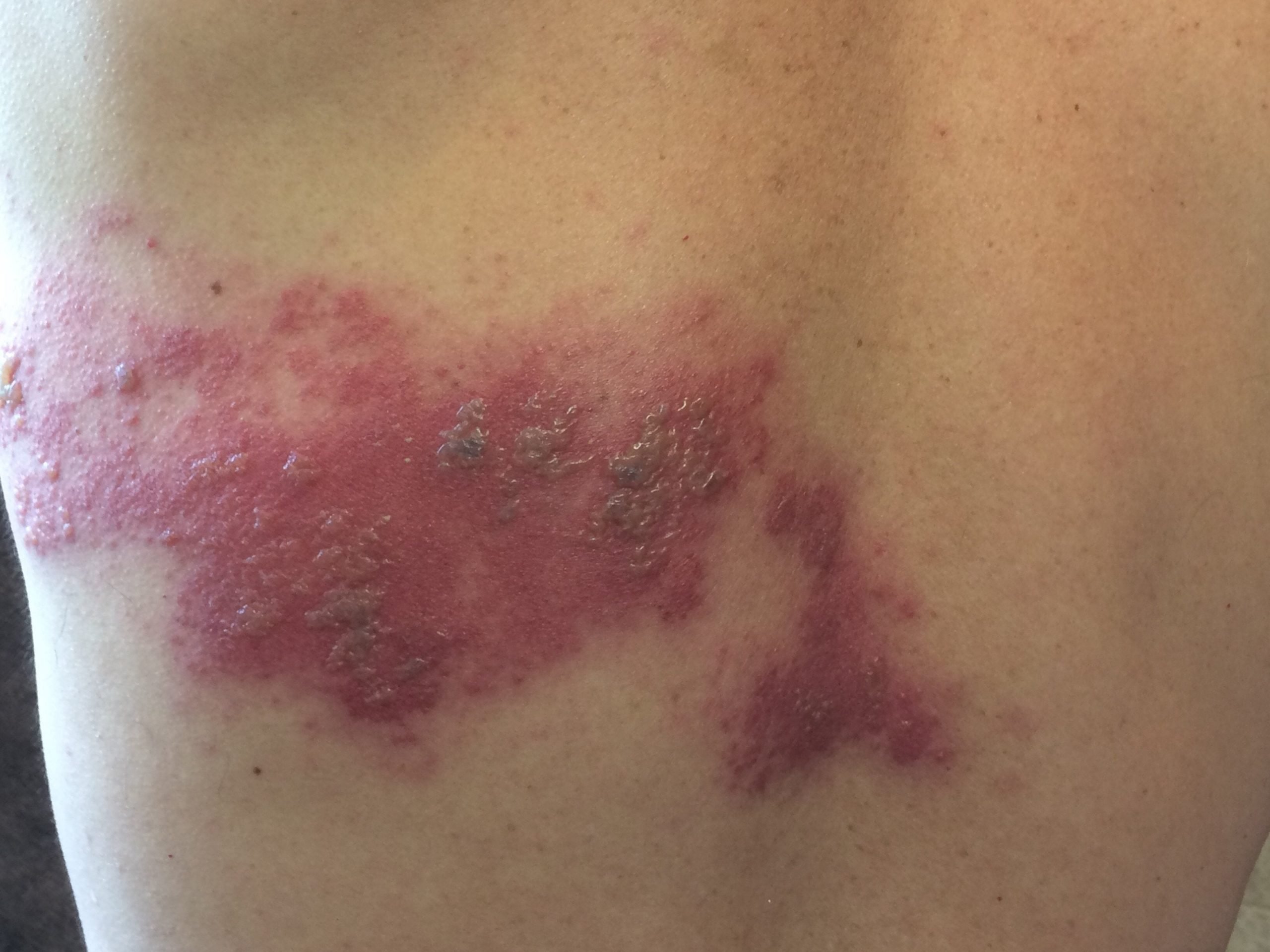 My Personal Experience with Severe Herpes Zoster (Shingles ...