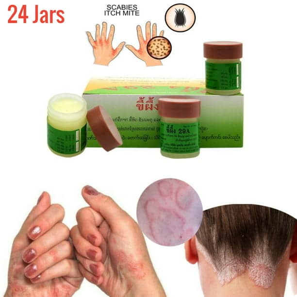 Natural Aid For Scabies, Psoriasis, Jock Itch, Ringworm, Herpes ...