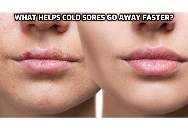 Natural Cold Sores Treatment  What Helps Cold Sores Go Away Faster ...