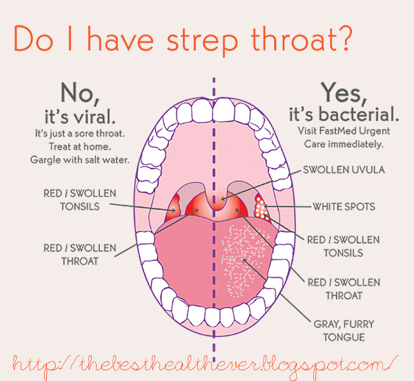 Natural Home Remedies for Strep Throat