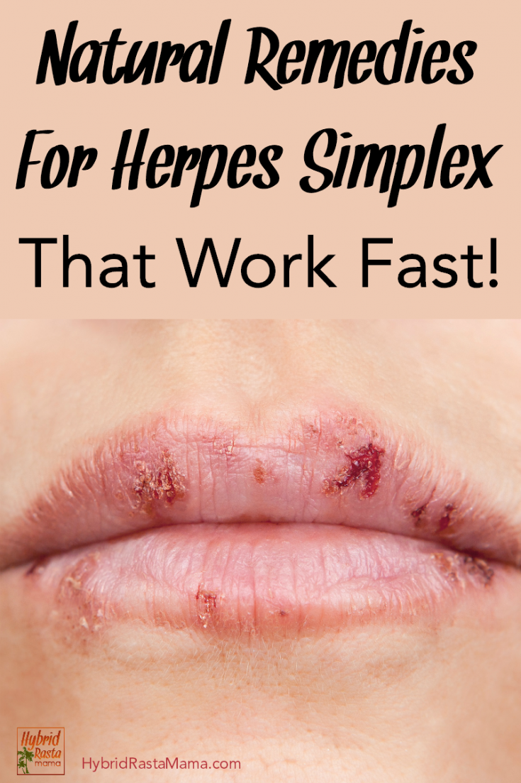 Natural Remedies For Herpes Simplex