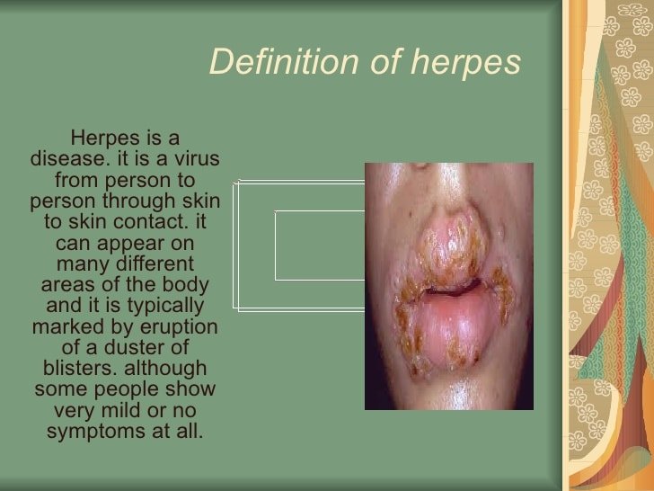Nerve pain with herpes, herpes definition