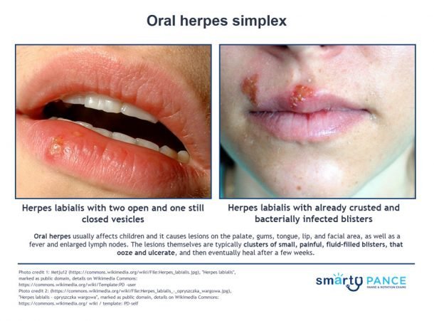 Oral herpes simplex (ReelDx)