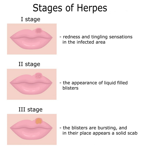 Oral Herpes: Symptoms, Causes, &  Treatments