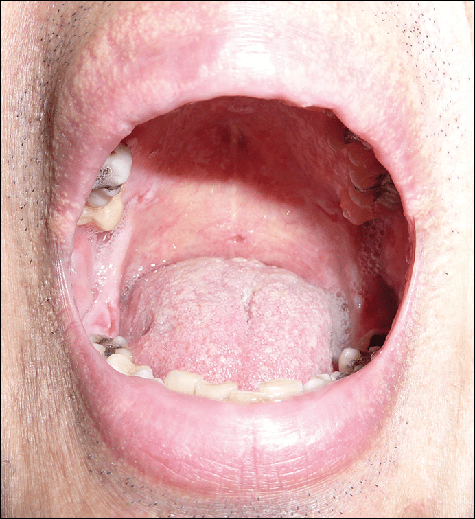 Painful Oral and Genital Ulcers