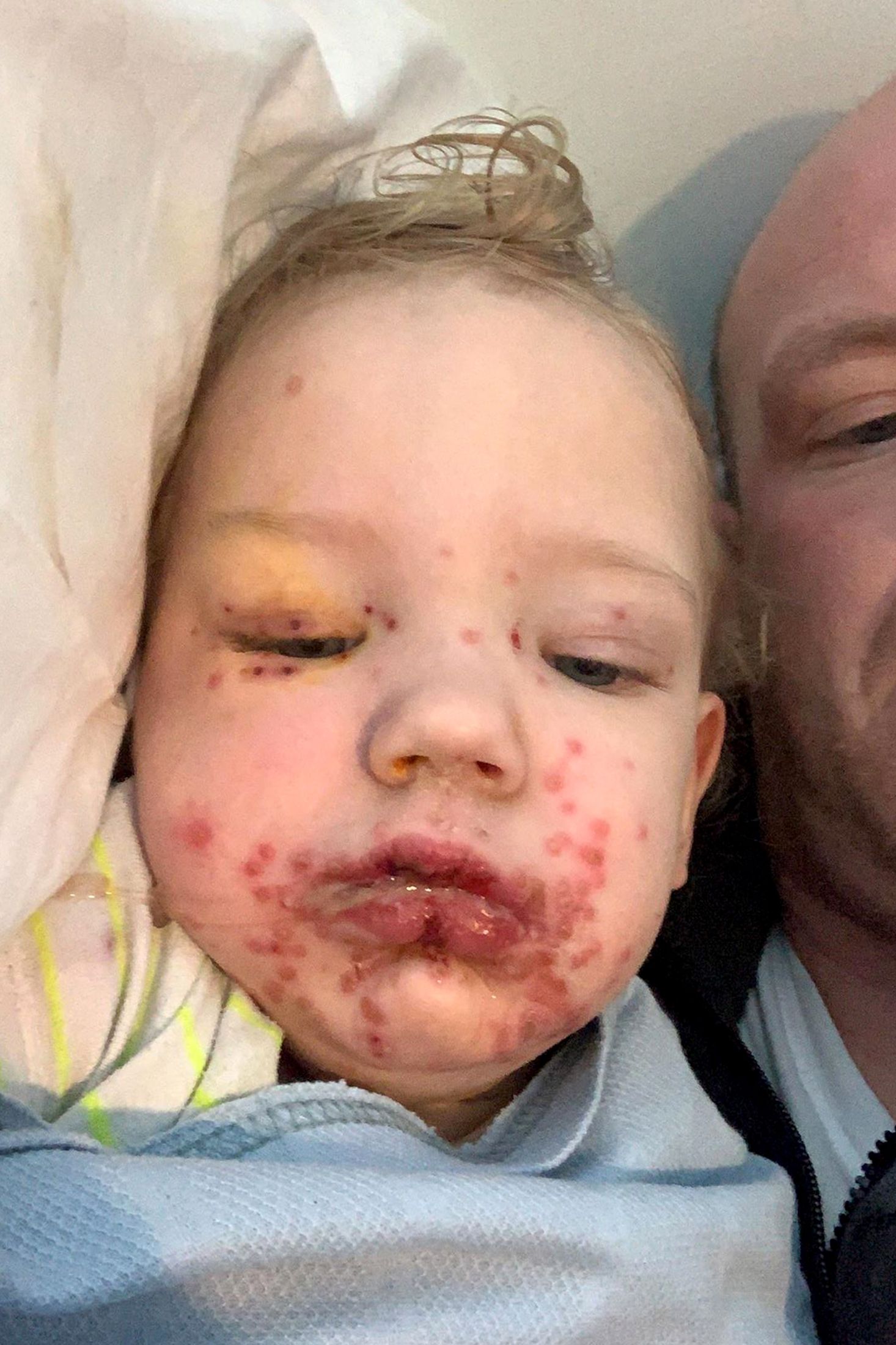 Parents of toddler ravaged by herpes across face shares photo as ...