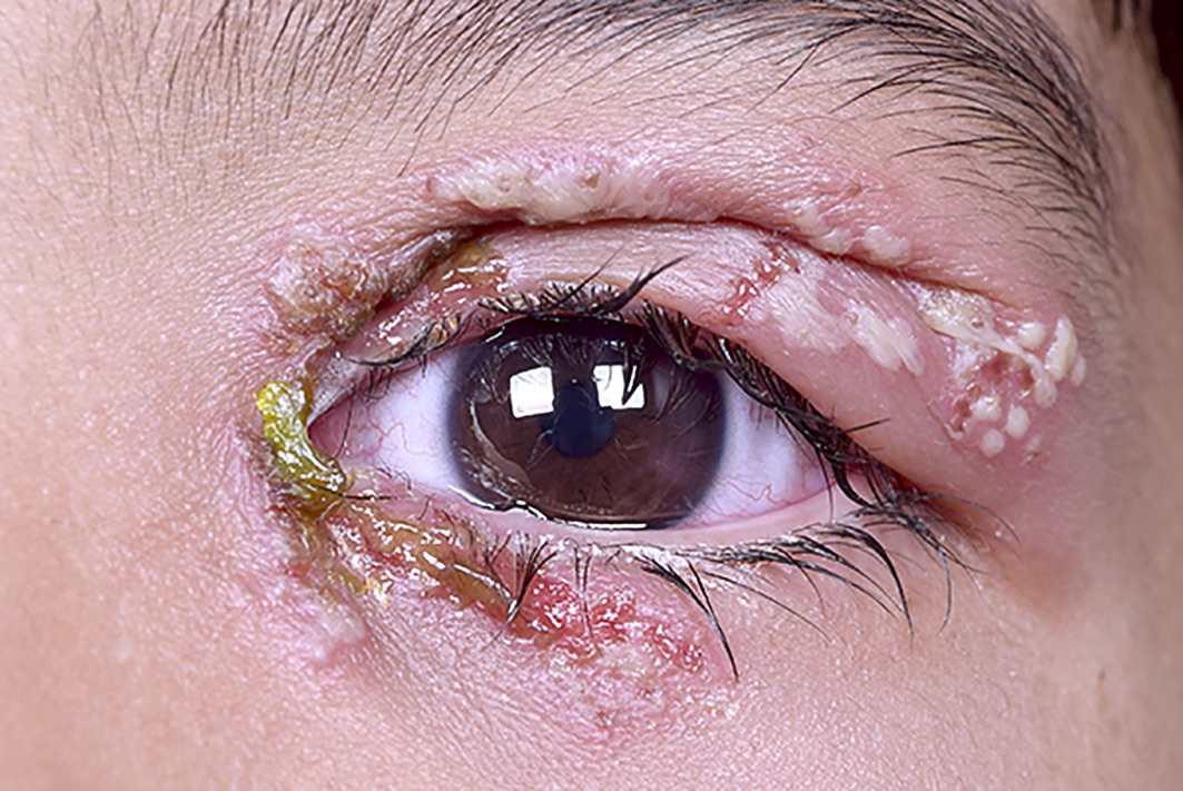 PHFI CEHJ » Herpes simplex infection of the eye: an introduction