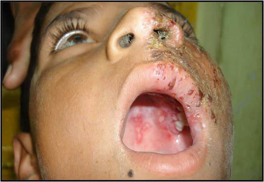 Pictures Of Herpes On Lips