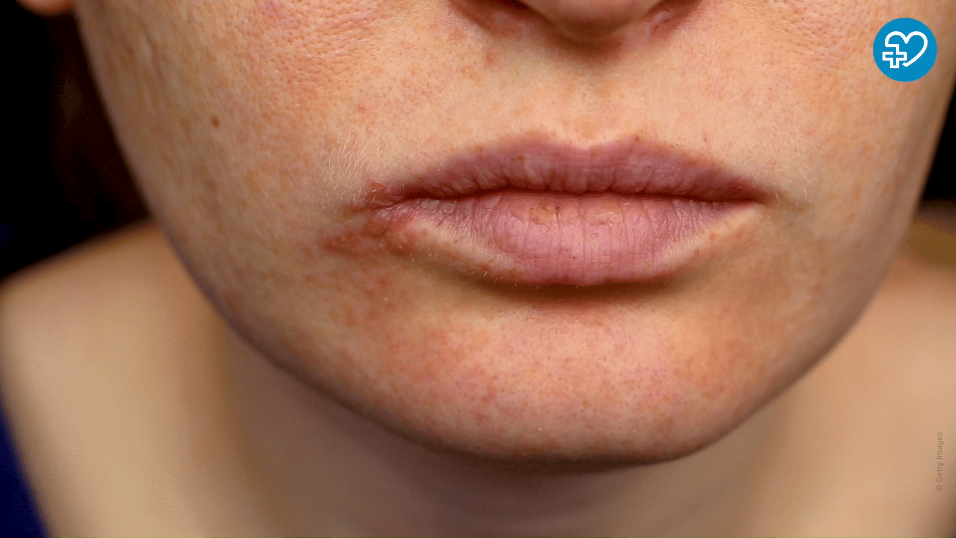 Pin on Herpes Treatments