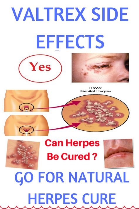 Pin on Home Remedies for Herpes