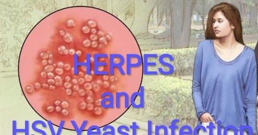 Pin on yeast infection remides