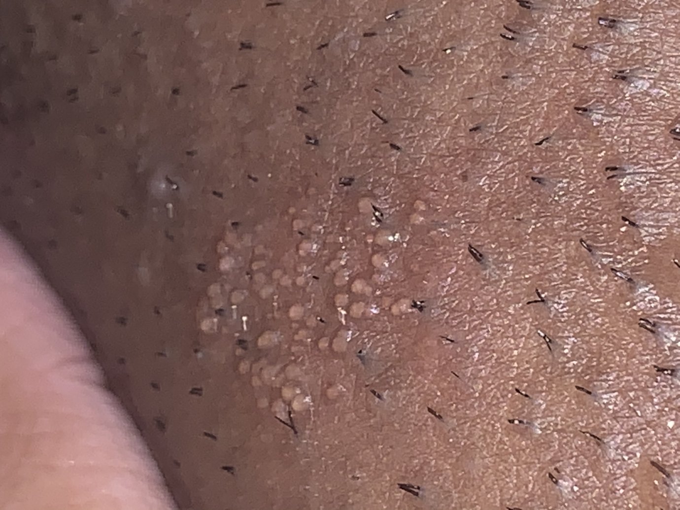 Please help . Is this herpes ??