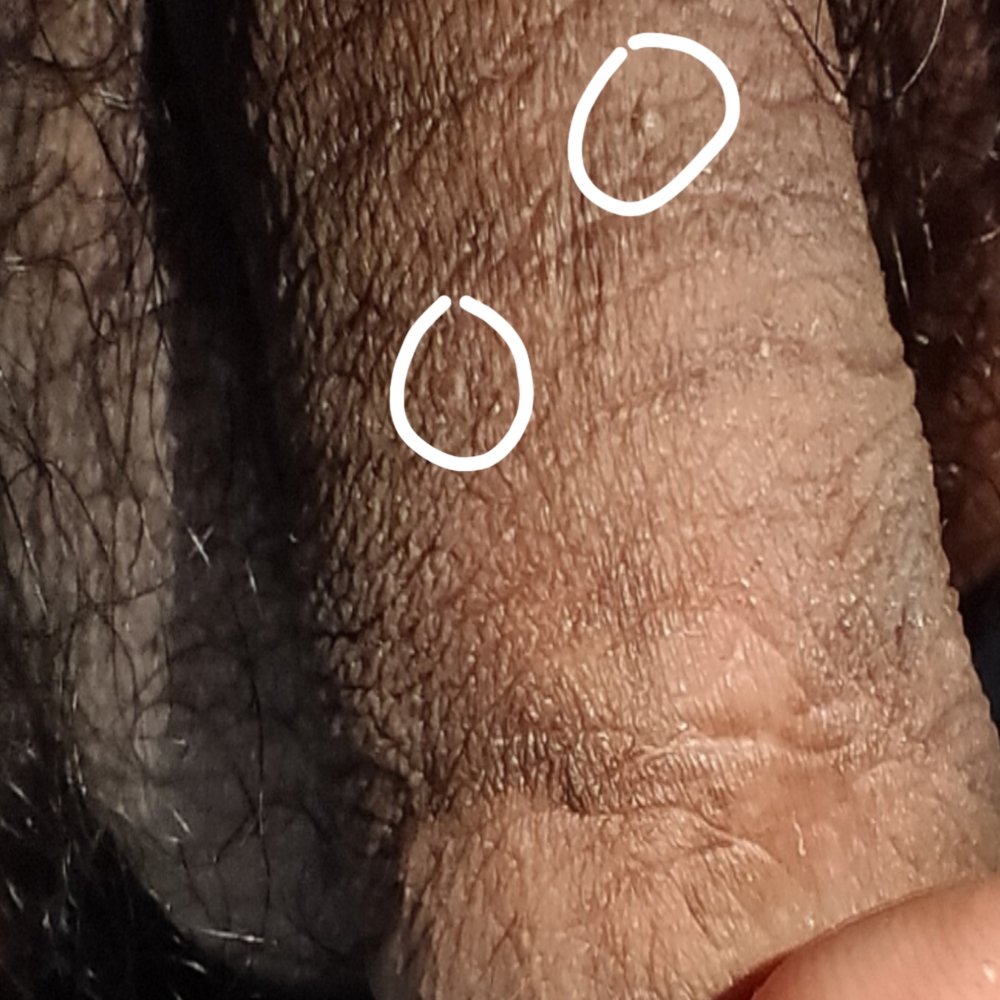 Pls help is this a Genital Warts or Sebaceous Gland