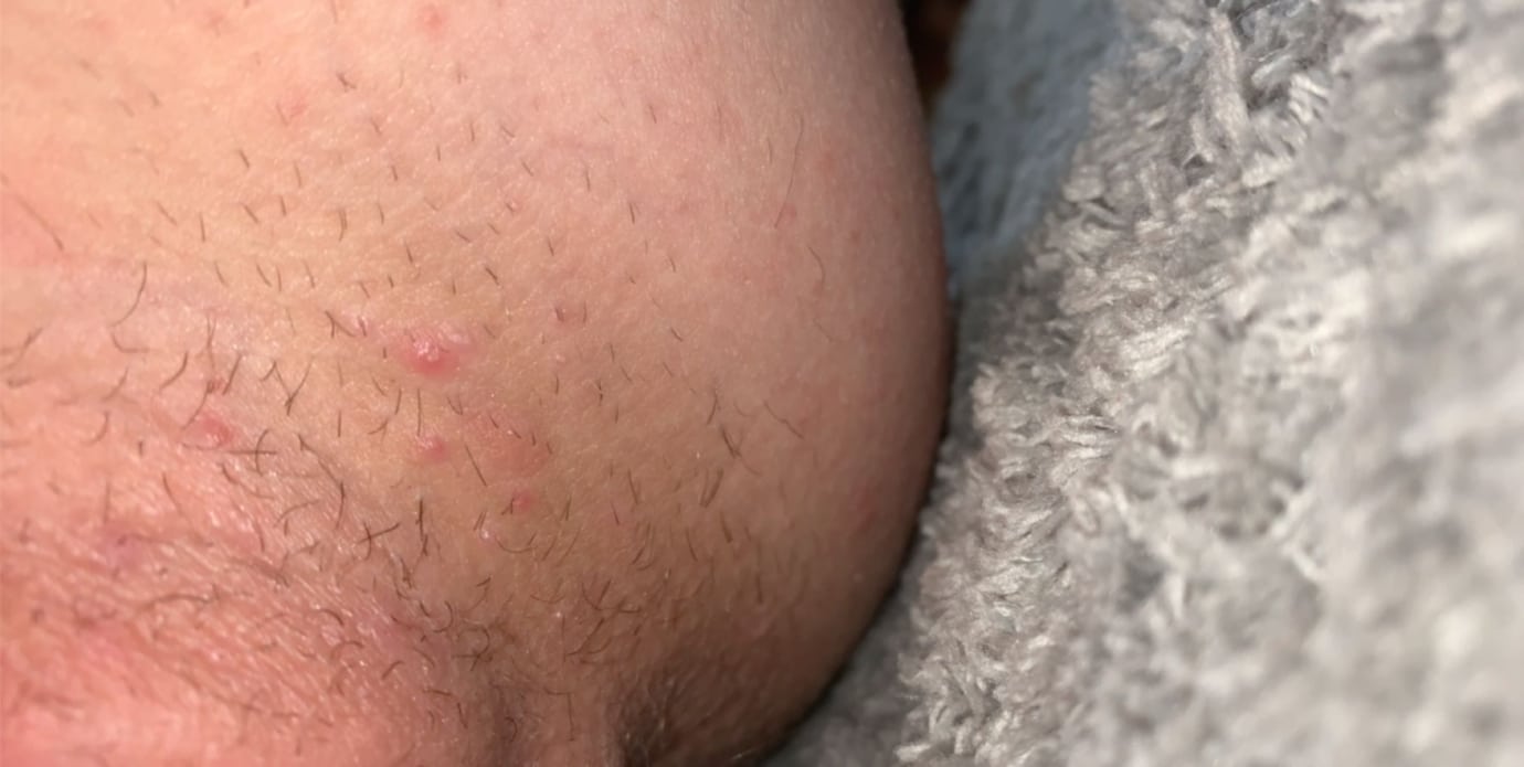 Possible Herpes or?