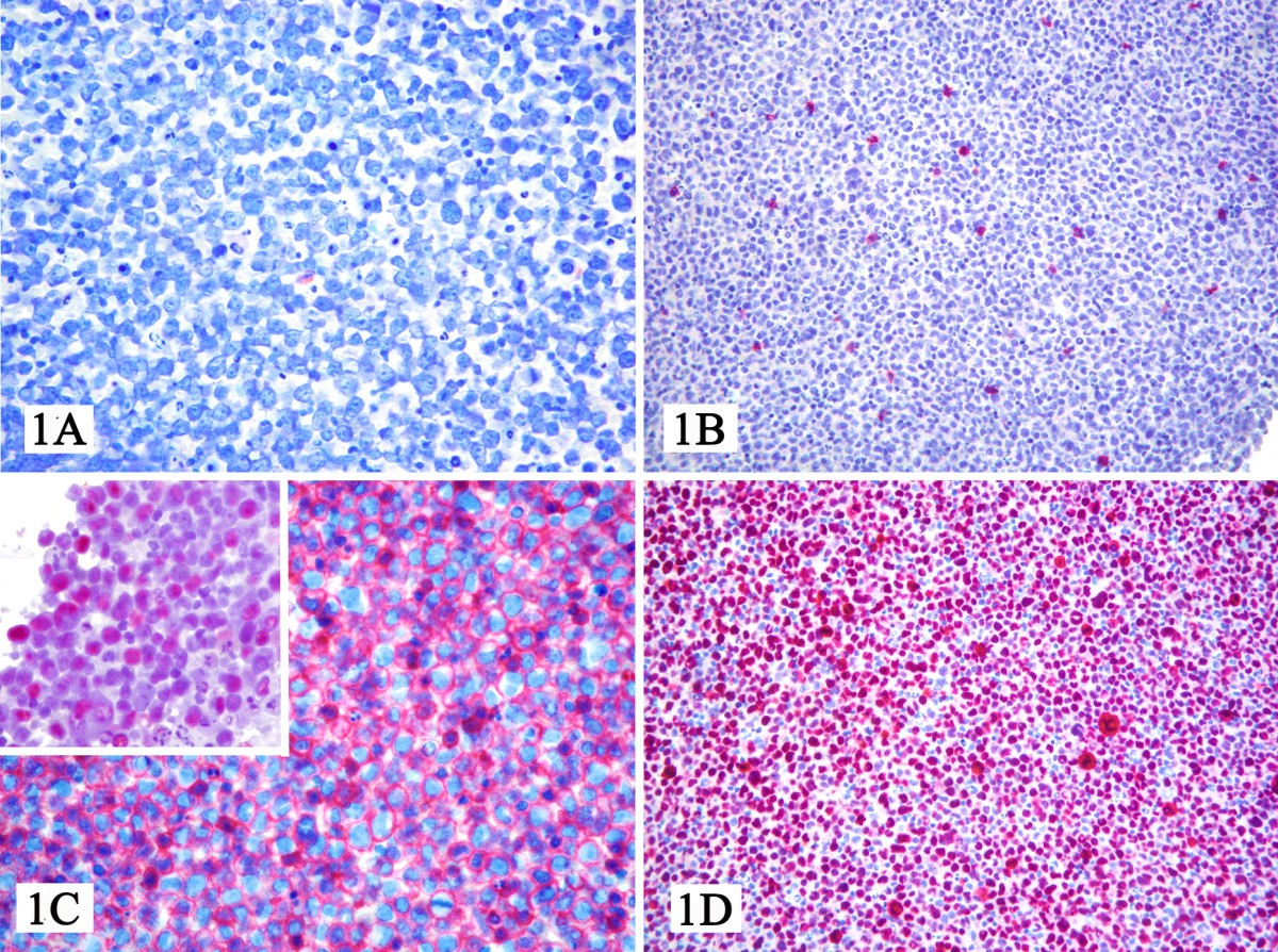 Primary effusion lymphoma associated with Human Herpes Virus