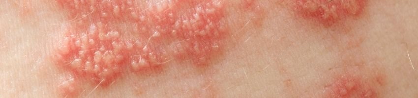 Raised red bumps and blisters caused by the herpes