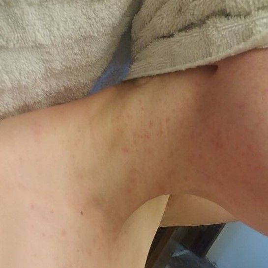 Rash for over one year now. Can anyone help? Folliculitis? Contact ...