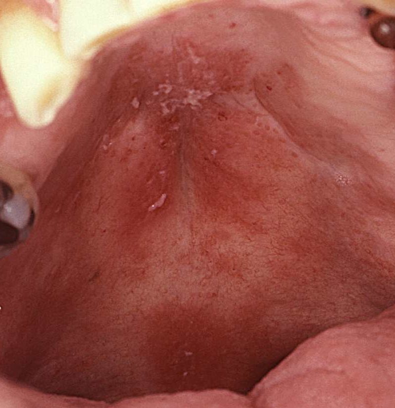 Red spots on roof of mouth: Causes and other symptoms