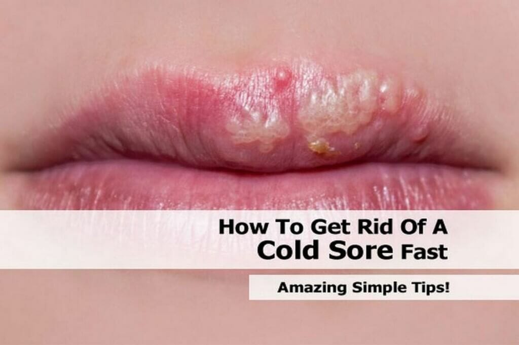 Relief for Cold Sore Sufferers