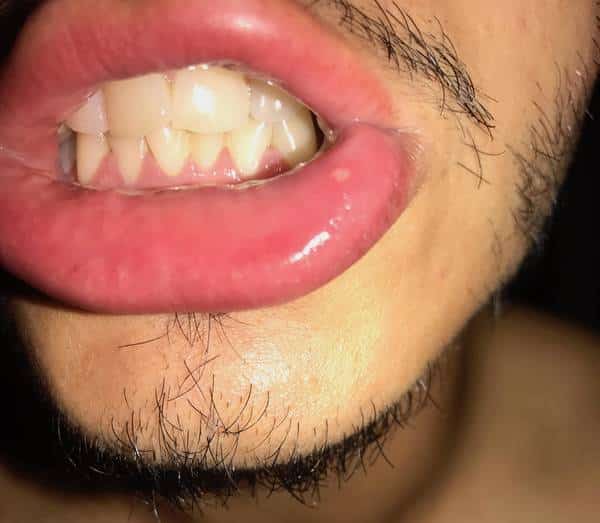 Responses: Oral herpes tongue