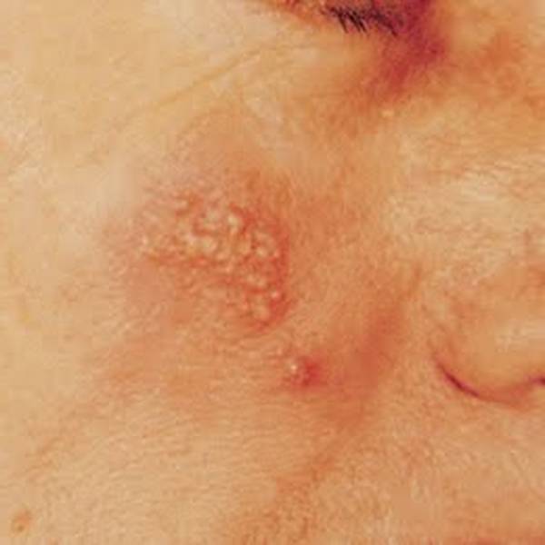 Secret revealed: Does herpes go away