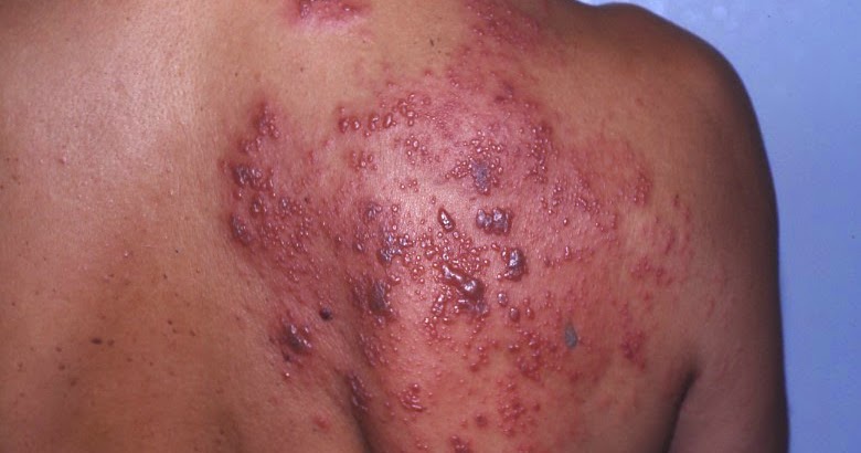 Several Easy Home Treatments to Cure and Prevent the Herpes Symptoms Men