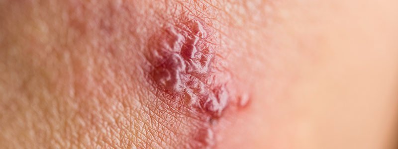 Shingles (Herpes Zoster) FAQs