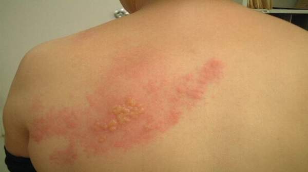 Shingles Herpes Zoster Treatment, Causes, Symptoms ...