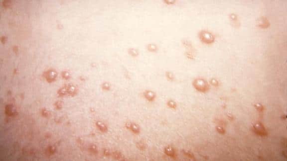 Shingles vaccine side effects mostly mild, CDC says