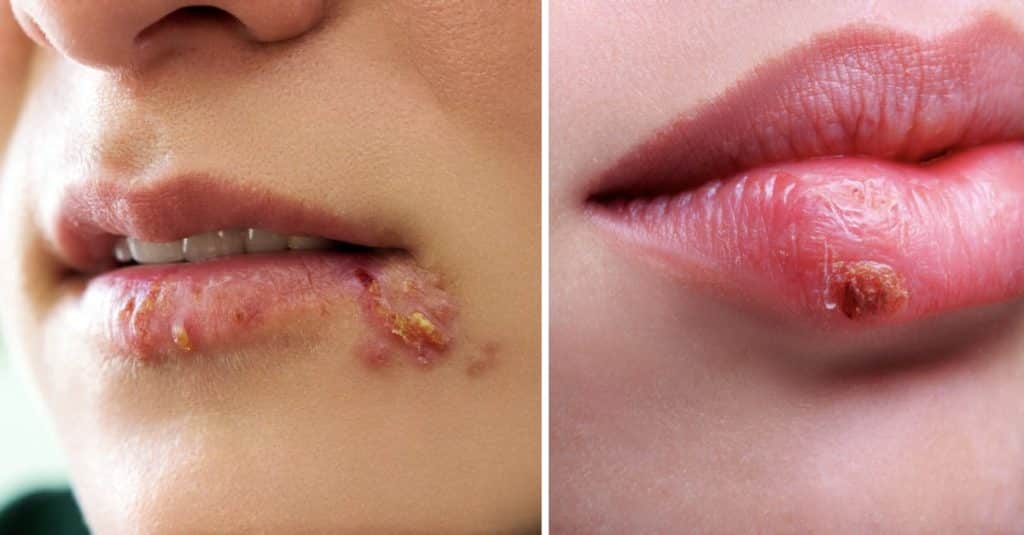 Signs of Herpes You Should Never Ignore